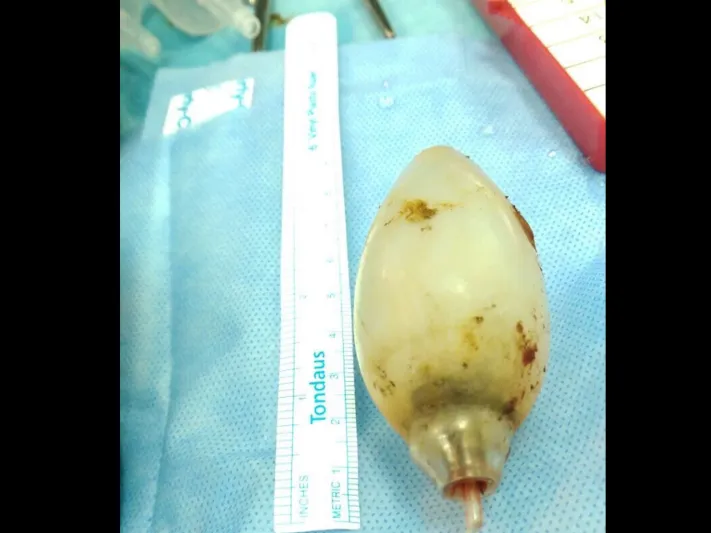 بعد 11 سنة.. اكتشاف لمبه داخل معدة مقيم آسيوي