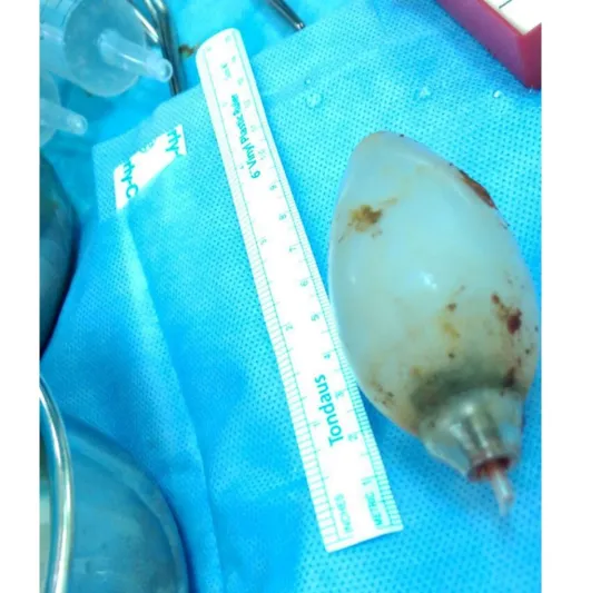 شاهد إزالة لمبة من بطن آسيوي في الأحساء