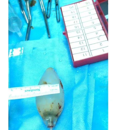 شاهد إزالة لمبة من بطن آسيوي في الأحساء