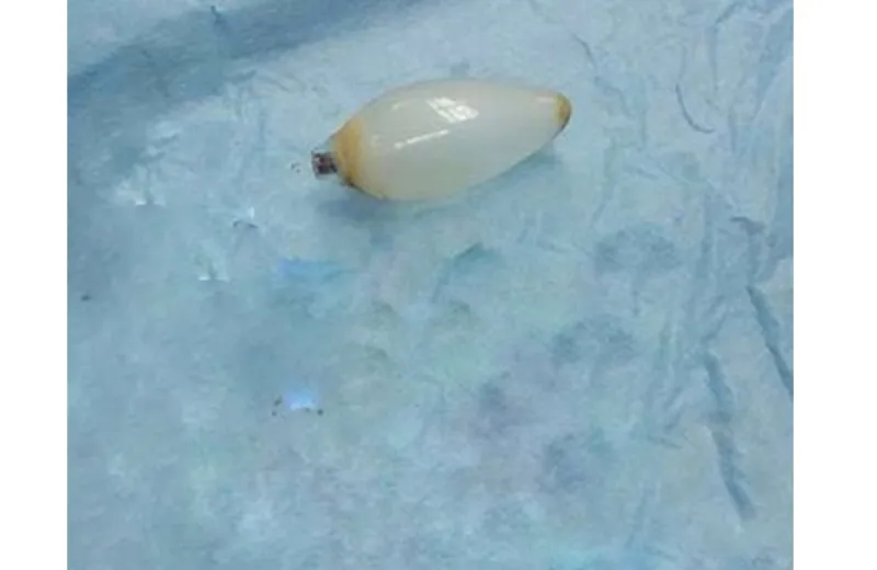 شاهد إزالة لمبة من بطن آسيوي في الأحساء