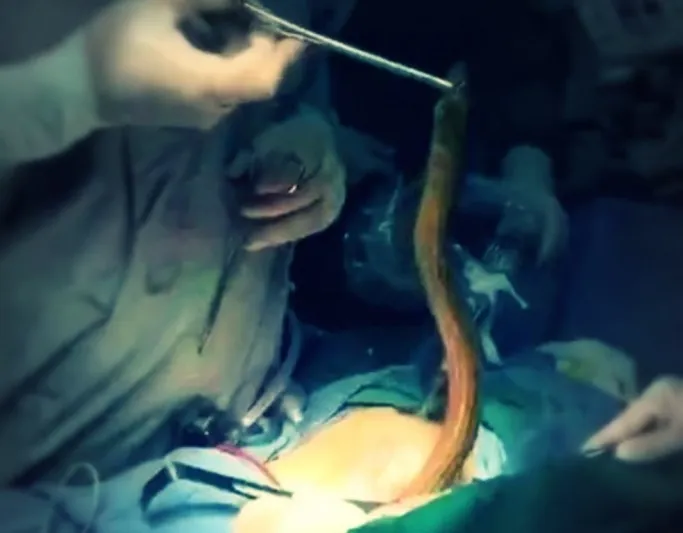 شاهد| أطباء حيواناً كان لا يزال حيًا من معدة مريض!