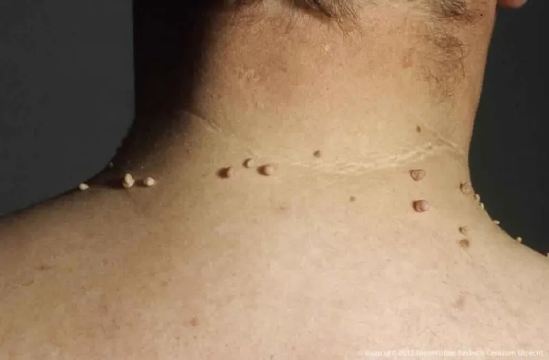 بسهولة وبدون ألم.. طريقة إزالة الزوائد الجلدية دون مغادرة منزلك