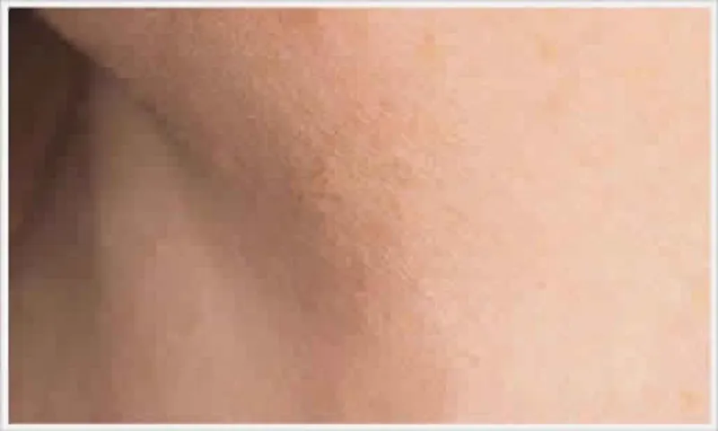 بسهولة وبدون ألم.. طريقة إزالة الزوائد الجلدية دون مغادرة منزلك