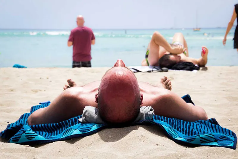 ماذا تعرف عن تسمم الشمس؟ عندما يتخطى الأمر الحروق