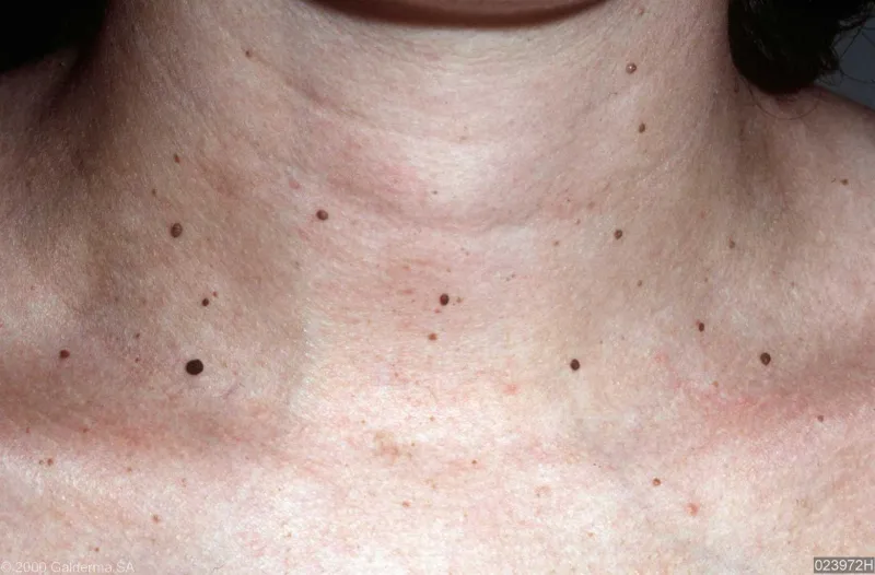 بسهولة وبدون ألم.. طريقة إزالة الزوائد الجلدية دون مغادرة منزلك