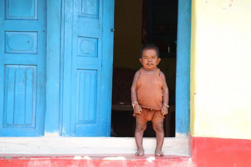 قصة رجل بملامح طفل.. عمره 50 عامًا ويزوره البشر من حول العالم