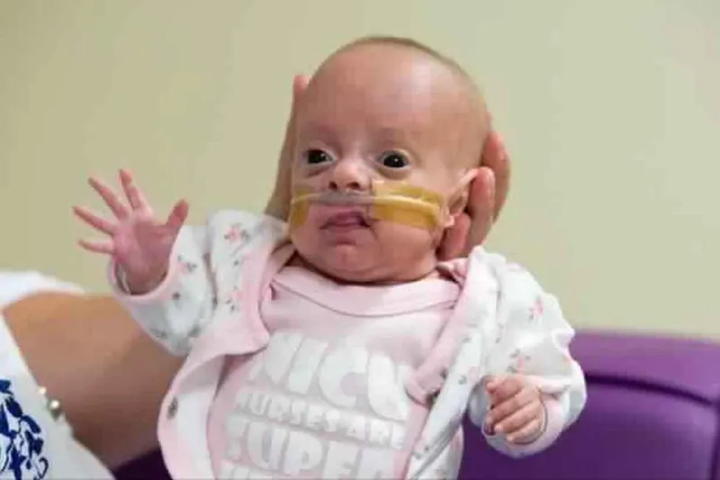 شاهد| معجزة نجاة أصغر طفلة بالعالم.. «ولدت بحجم كرة التنس»