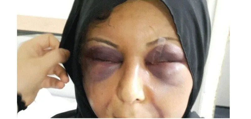 خليجي يشوه وجهه زوجته للزواج بأخرى تعيله