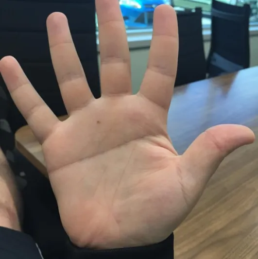 صفات وخصائص جسدية نادرة.. هل تملكها ؟