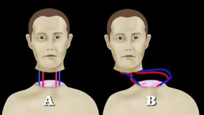 أحدث تطورات أول عملية زراعة رأس بالعالم (فيديو)