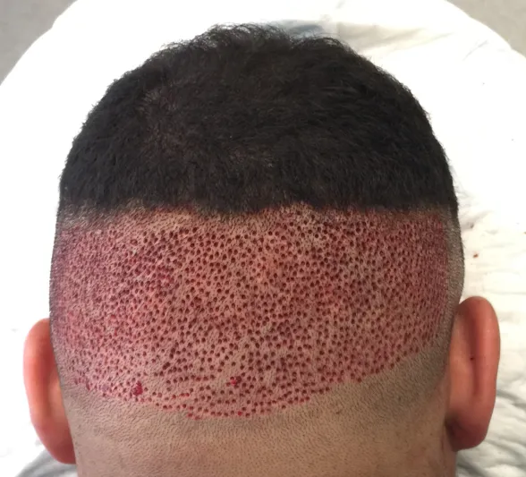 وداعاً للصلع ..زراعة شعر بسرعة فائقة وبدون أي ألام !