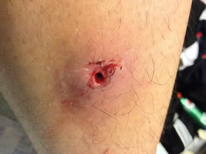 احذر من خدش موضع لدغة البعوض.. الأمر أخطر مما تتخيل 