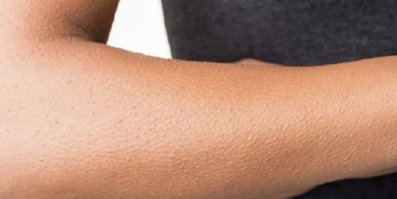 بشرى.. القشعريرة مؤشر للسعادة والصحة الجسدية والعقلية