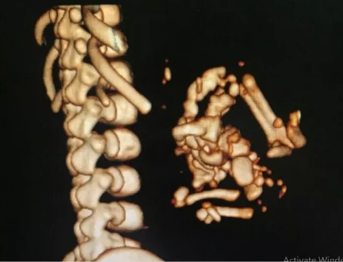 تحدث كل خمسمائة ألف حالة.. إجراء عملية ولادة نادرة لـ" جنين داخل جنين" بالطائف