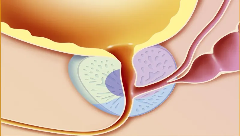 جميع أنواع أعراض البروستاتا وكيفية التخلص منه نهائيا