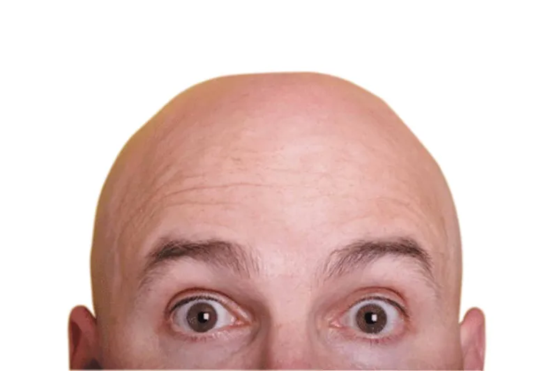 أهم أسباب الصلع عند الرجل .. ابتعد عن هذه الأشياء