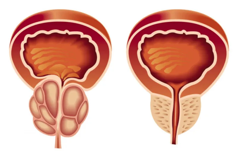 ما هي أعراض وأسباب التهاب البروستاتا وطرق العلاج؟