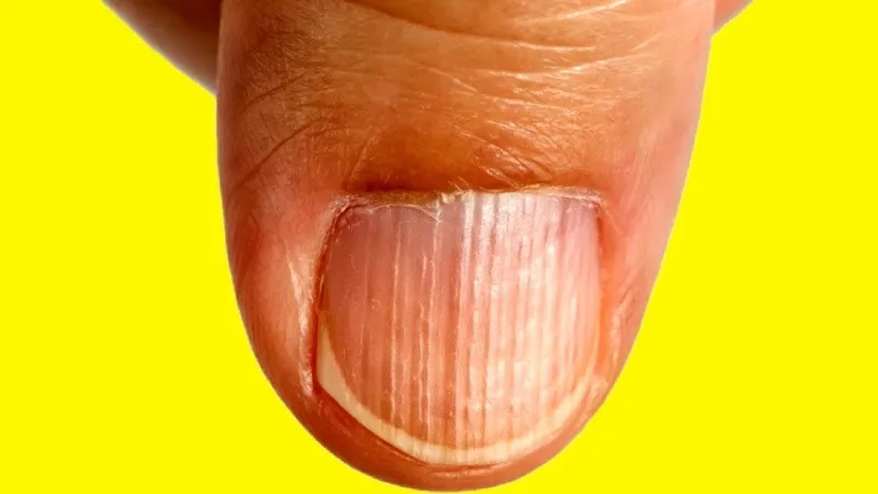 إذا ظهرت لديك هذه العلامات.. فأنت تعاني من نقص البروتين