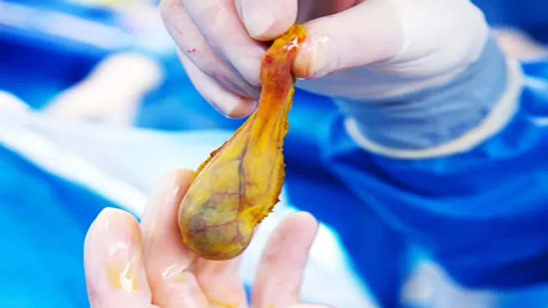 جراحات استئصال المرارة لا حاجة للمرضى إليها.. أطباء يفجرون مفاجأة 