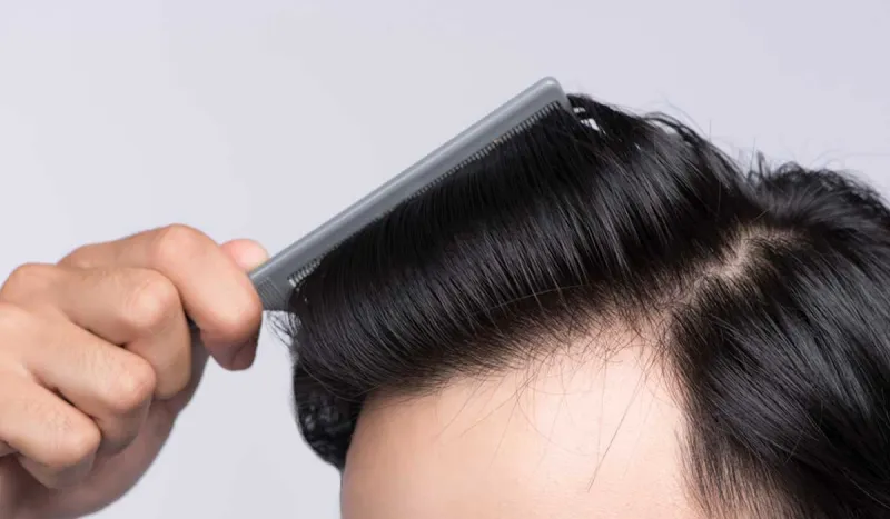 نسب نجاح عالية.. تكلفة زراعة الشعر في مصر 2019