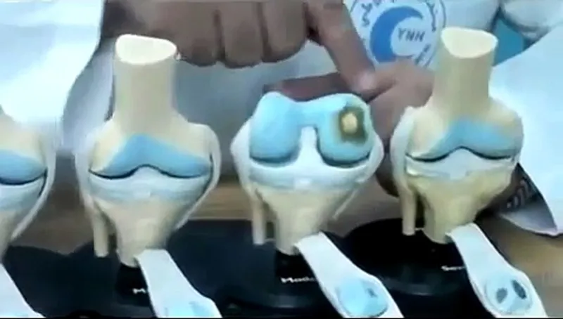 أفضل علاج لخشونة الركبة بطرق طبيعية