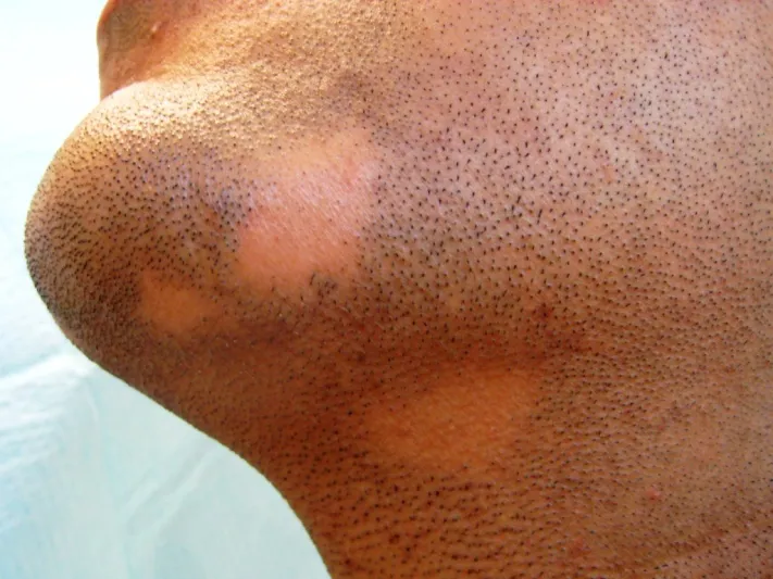 ثعلبة الذقن وطرق علاجها بالأعشاب