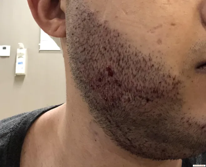 ثعلبة الذقن وطرق علاجها بالأعشاب