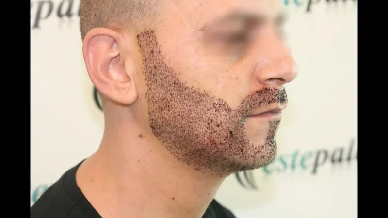 ثعلبة الذقن وطرق علاجها بالأعشاب