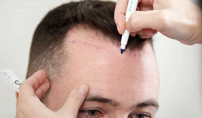 أضرار زراعة الشعر الطبيعي