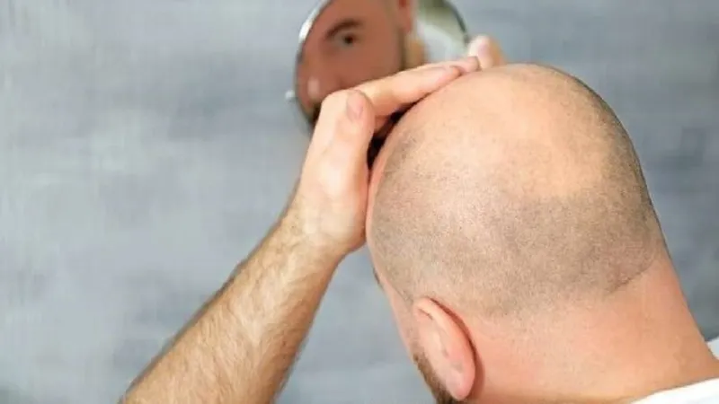 ثورة علمية.. علاج متطور يقضي على الصلع تماما