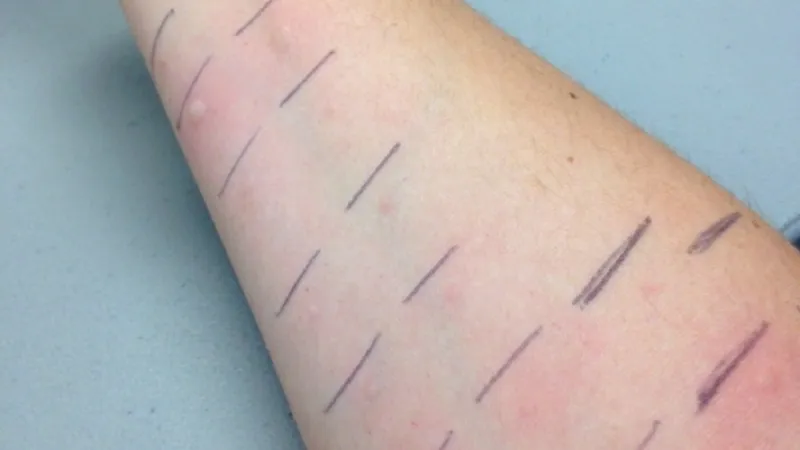 الحساسية تهدّدكم في الخريف أيضاً.. هكذا تتجنبونها