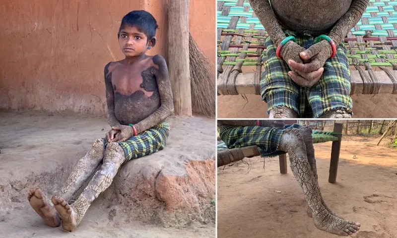 جسم من حجر.. كيف تسبب مرض «السماك» في تألم طفلة هندية؟ «فيديو»