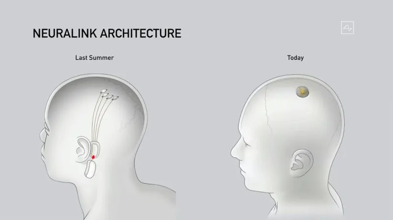 شريحة ايلون ماسك شريحة neuralink: الحقائق والمخاوف