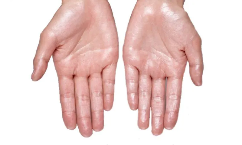 أسباب تعرق القدمين واليدين.. كيف تسيطر على هذه الظاهرة؟