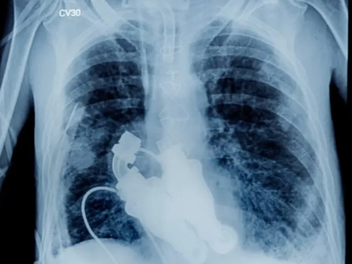 الرجل المعجزة.. قصة أول إنسان حي في العالم يعيش دون قلب (فيديو)