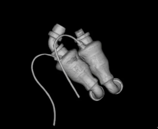 الرجل المعجزة.. قصة أول إنسان حي في العالم يعيش دون قلب (فيديو)