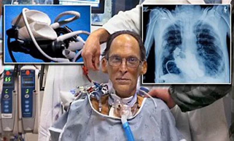 الرجل المعجزة.. قصة أول إنسان حي في العالم يعيش دون قلب (فيديو)