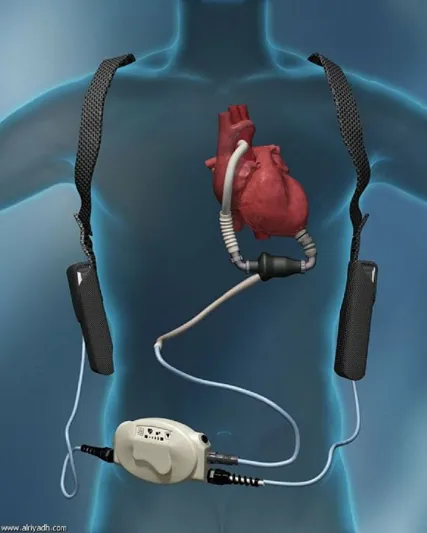 كيف عاش شاب 18 شهراً بلا قلب؟ (فيديو) 