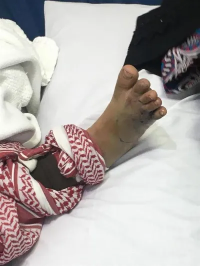 لدغة أفعى سامة تنقل طفلة في السعودية للعناية المركزة (صور) 