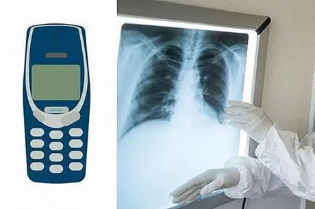 طبيب يكتشف هاتفًا محمولاً في معدة سجين