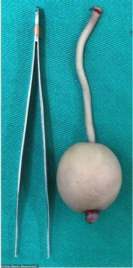 طفل يولد بذيل وكرة في نهايته والأطباء يفسرون الحالة (صور)