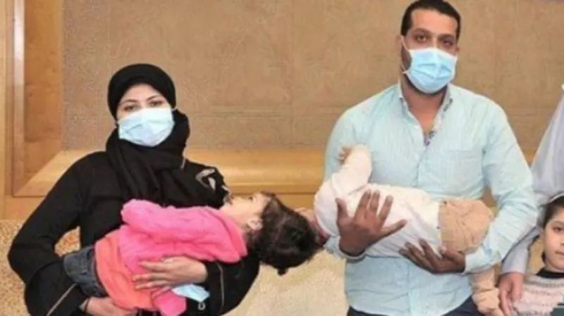 السعودية تحقق حلم طفلتين مصريتين ملتصقتي الرأس