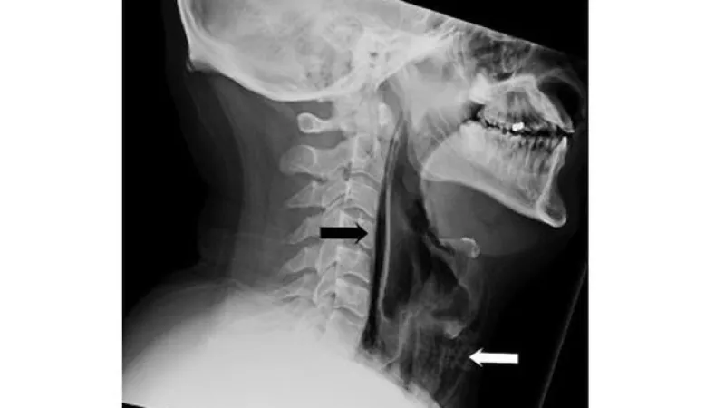 خطر يهدد حياتك..ماذا يحدث لجسمك عند كتم العطس؟ 