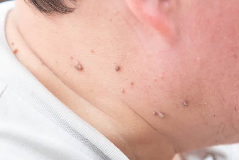 علاج الثآليل في الرقبة عند الرجال.. طرق منزلية وطبية مجربة