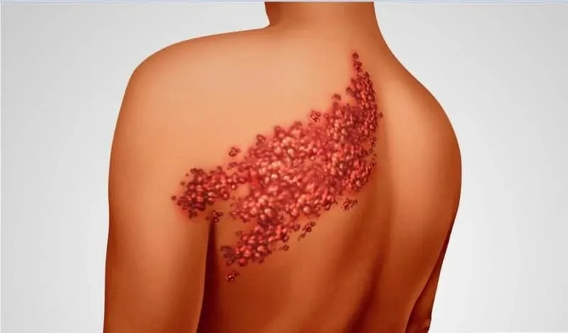 كل ما تريد معرفته عن مرض الحزام الناري