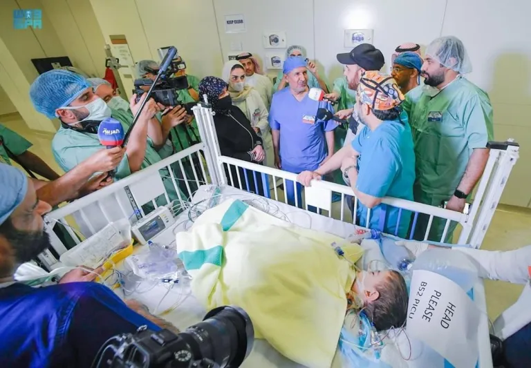 نجاح فصل التوأم السيامي السوري "إحسان وبسام" بالمملكة (صور)