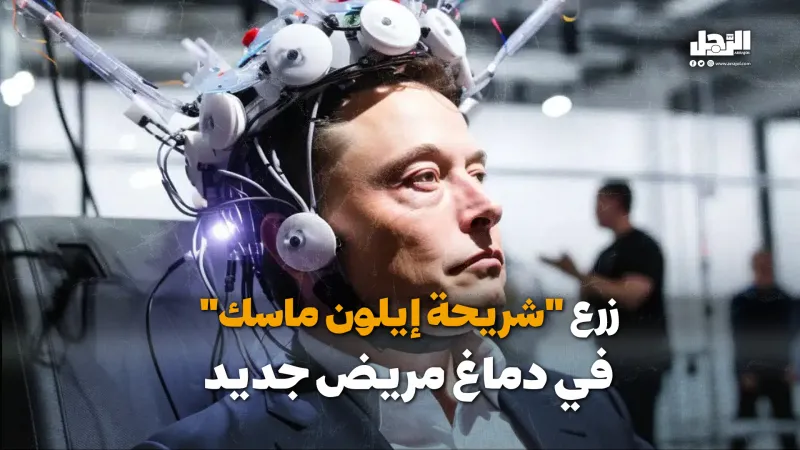 زرع "شريحة إيلون ماسك" في دماغ مريض جديد (فيديوجراف)