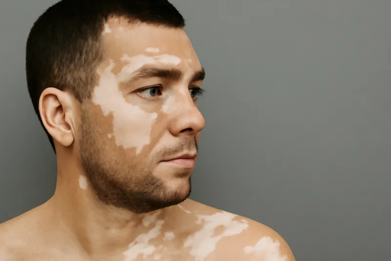 في اليوم العالمي للبهاق: ما الذي لا تعرفه عن هذا المرض؟ 