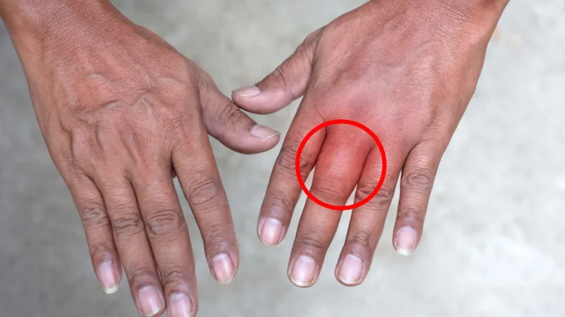 هل تسبب فرقعة الأصابع ضررًا للمفاصل؟ دراسة تُجيب