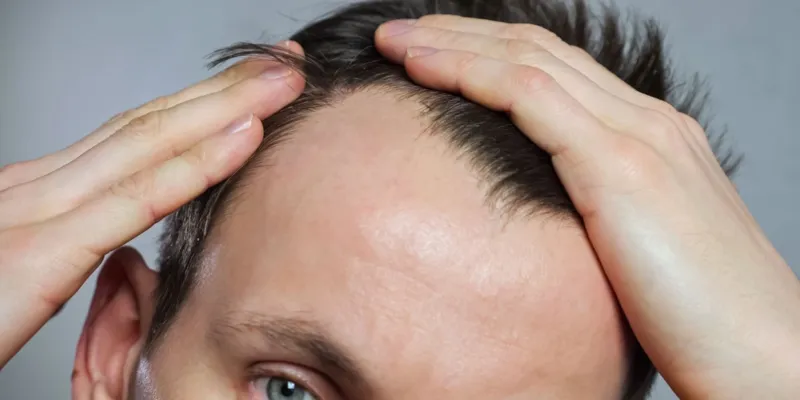  دراسة تحذر: "فيناسترايد" لعلاج الصلع قد يكون مسببًا لمشاكل نفسية خطيرة